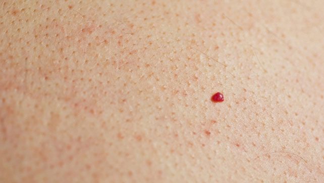 How to Remove a Cherry Angioma