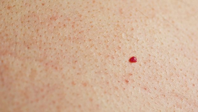 Cherry Angiomas (Blood Spots)