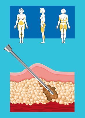 How Liposuction Works