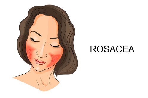 illustration of rosacea on the girl's face