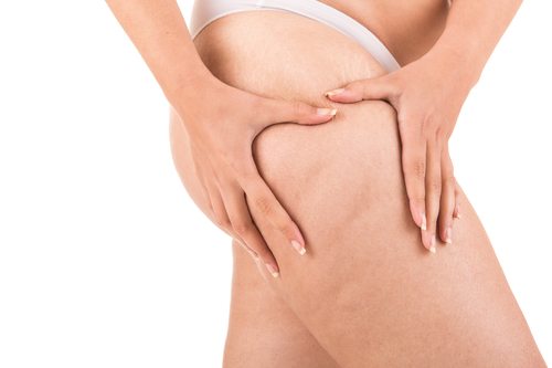 Reducing the Appearance of Cellulite