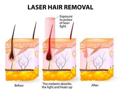 How Does Laser Hair Removal Work?