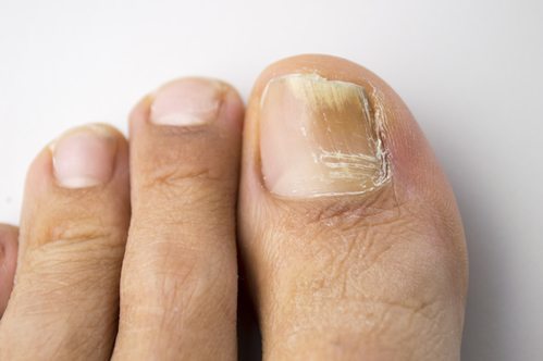 Nail Fungus Treatment