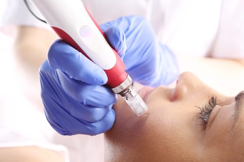 woman receiving needle mesotherapy
