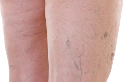 How Does Laser Vein Treatment Work?