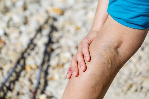 varicose veins