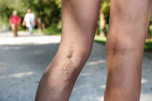 What Causes Spider Veins?