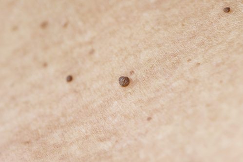 What Are Skin Tags?