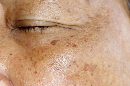 woman's eye and cheek with irregular skin pigmentation